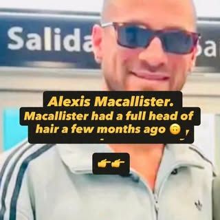 ‼️ Hair Transplant Reality ‼️

Alexis Macallister recently went bald for a hair transplant BUT….

Ju