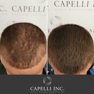 Hair Transplant ❌

SMP Repair ✅

Capelli Inc Magic 🪄🪄🪄

DM to enquire about SMP Treatment or Trai