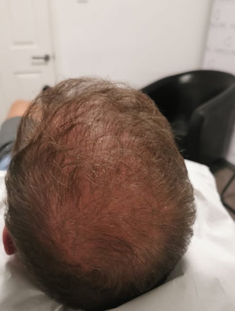 Swipe 👉👉👉

The difference a few hours can make. 

Client has previously had a Hair Transplant ❌

