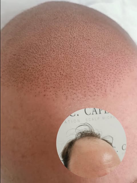 Zoooooom 👀

Go and have a little snoop around the quality in these Scalp Micropigmentation SMP ‘Hai