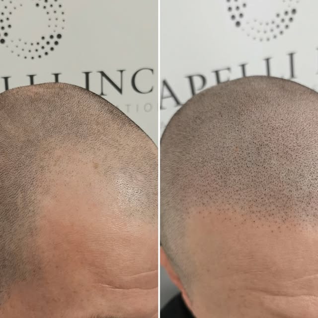 🤷‍♂️

Have a little zoom 🔎

Scalp Micropigmentation SMP with Ant at Capelli 🥇 

‼️LIMITED SPACES 