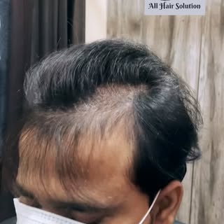 Say good bye to baldness in just 60 mins.
Get hair patches which looks like natural hair.
..
...
..
