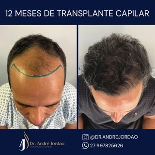 1 ano entre as fotos, vamos mudar sua autoestima? Aproveite a promoção de black friday, agora é a me