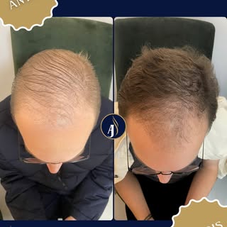 🔥 Resultado de verdade começa antes do transplante.

Este paciente iniciou a terapia capilar para f