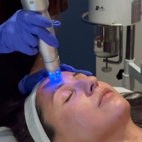 Ready to glow all summer? Scarlet RF boosts collagen to help smooth acne scars, tighten skin, soften
