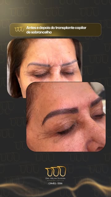 Mudando mais um olhar! 

Com NATURALIDADE!

#transplantecapilar #fue #fiolongo #sobrancelhas