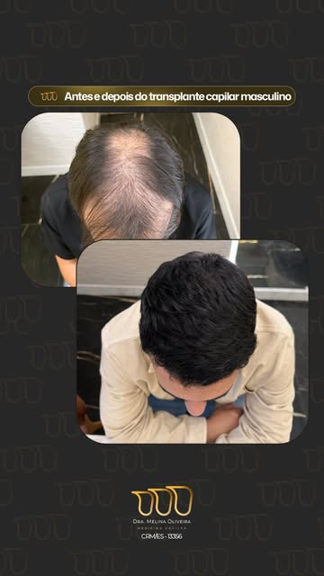Seis meses depois. O resultado fala por si só.

Esse paciente chegou com rarefação intensa no topo d