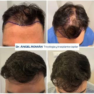 Tenemos el placer de presentaros un nuevo caso exitoso de trasplante capilar en paciente con Alopeci