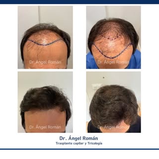 Resultado de trasplante capilar en paciente con Alopecia Androgenética NH VI. Espectacular el cambio