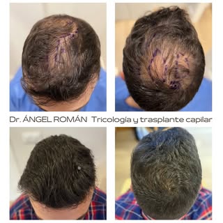 Evolución de paciente con Alopecia Androgenética en vértex y zona media tras realización de trasplan