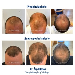 Espectacular evolución de paciente joven con Alopecia Androgenética precoz en tan solo 5 meses de tr