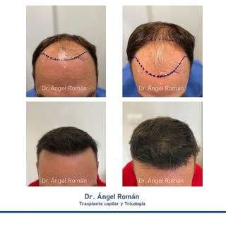 Paciente con Alopecia androgenética grado H-N V, con evolución tras 10 meses de trasplante capilar c