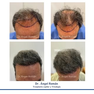 Paciente con alopecia androgenética que acaba de cumplir su sexto mes postrasplante capilar. Nos eno