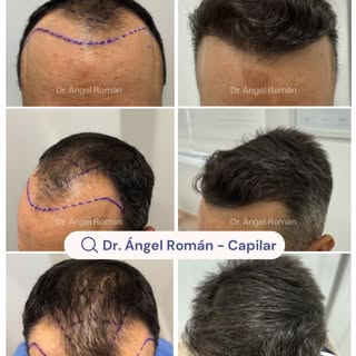 IMPRESIONANTE CAMBIO!!!!

Paciente muy contento y satisfecho con el resultado obtenido tras la reali