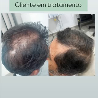 ✨Antes e depois que fala por si🫡

Esse cliente está em tratamento com Terapia Capilar e os resultad