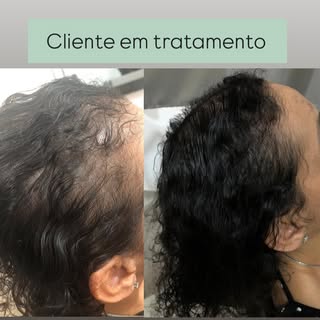 ✨ Terapia Capilar Funciona 

Antes: fios ralos e couro cabeludo visível 😩

Depois: cabelo mais chei