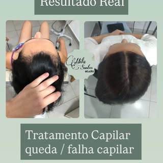Ela chegou com queda e falhas laterais, o cabelo estava perdendo força.

Após sessões de Terapia Cap