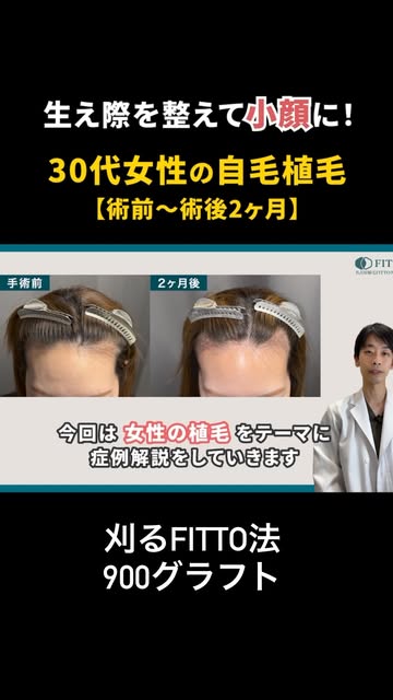【症例紹介】30代女性 刈るFITTO法 900グラフト

生え際を植毛で整え、丸いおでこを作ることで小顔効果を目指しました。

術前 → 術後2ヶ月までの経過を詳しく解説していますので、ぜひ最後まで