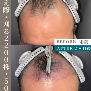 生え際が後退していることにお悩みだった50代男性の症例。
2200グラフトの刈るFITTO法(FUE)で自然に下がった生え際のラインを再現しました。

既存の毛を守りながら、違和感のない生え際へ。
“
