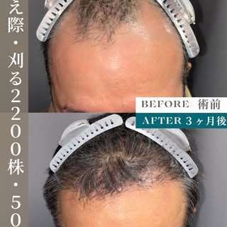 生え際が後退していることにお悩みだった50代男性の症例。
2200グラフトの刈るFITTO法(FUE)で自然に下がった生え際のラインを再現しました。

既存の毛を守りながら、違和感のない生え際へ。
“