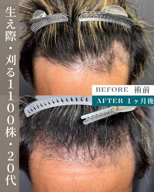 生え際が後退していることにお悩みだった20代男性の症例。
濡れた前髪を上げる際に特に気になっていました。
1100グラフトの刈るFITTO法(FUE)で自然に下がった生え際のラインを再現しました。


