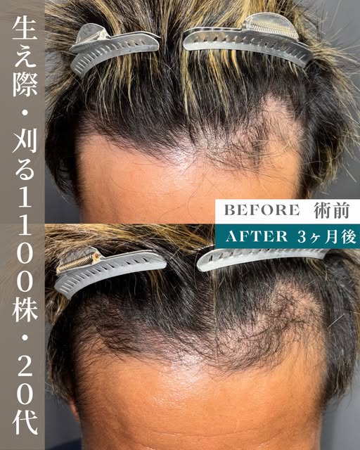 生え際が後退していることにお悩みだった20代男性の症例。
濡れた前髪を上げる際に特に気になっていました。
1100グラフトの刈るFITTO法(FUE)で自然に下がった生え際のラインを再現しました。

