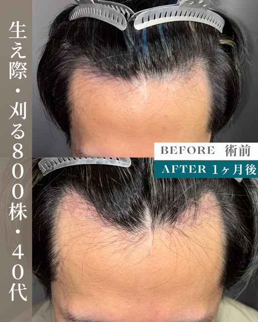 生え際が後退していることにお悩みだった20代男性の症例。
特に強風の時に気になっていました。
800グラフトの刈るFITTO法(FUE)で自然な生え際M字のラインを再現しました。

既存の毛を守りなが