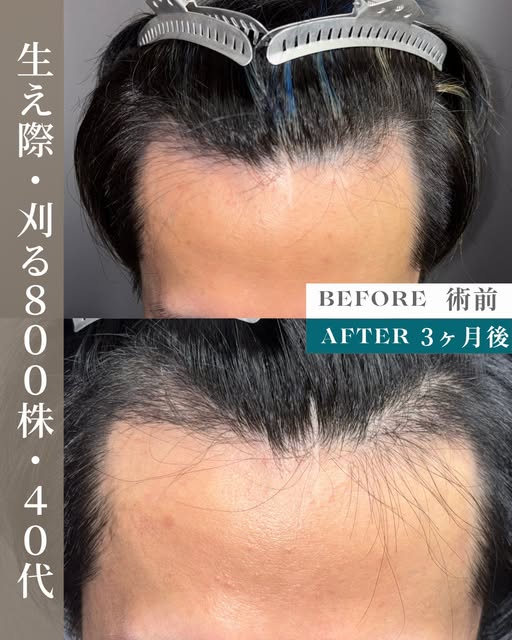 生え際が後退していることにお悩みだった20代男性の症例。
特に強風の時に気になっていました。
800グラフトの刈るFITTO法(FUE)で自然な生え際M字のラインを再現しました。

既存の毛を守りなが