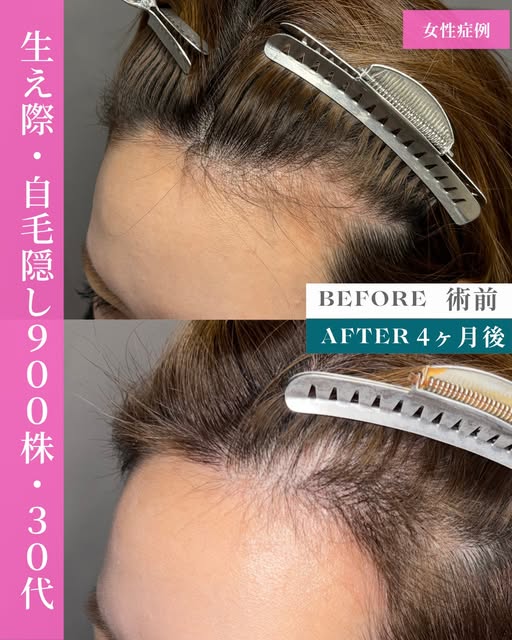【女性症例】
M字部分の毛量が少ないことにお悩みだった30代女性の症例。
900グラフトの自毛隠しFITTO法(FUE)で小顔効果を出しつつ、自然な毛量を再現しました。

既存の毛を守りながら、違和感