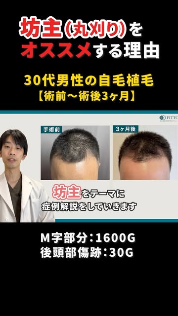  【症例紹介】30代男性 刈るFITTO法 
生え際1600グラフト＋後頭部傷跡30グラフト

実はおすすめ「丸刈り植毛」の症例を1分で解説！
丸刈りにするメリットや、施術前の注意点をまとめています。