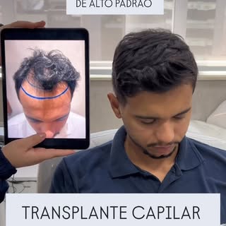 Transplante Capilar artificial ficou no passado! Sabendo escolher o profissional certo, ter os cabel