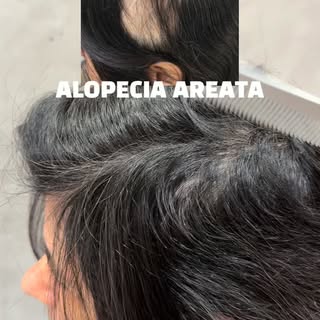 A alopecia areata pode surgir de forma inesperada, causando áreas de queda bem delimitadas e, muitas
