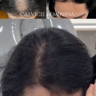 Na calvície feminina, a queda de cabelo vai muito além da perda dos fios. Ela pode afetar a autoesti