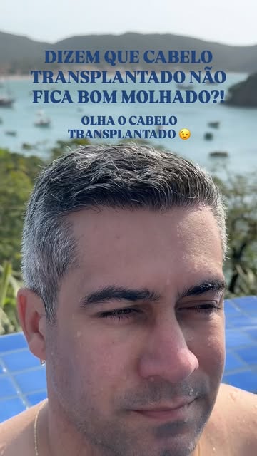 💦 Cabelo transplantado bem feito fica bom até molhado.

Porque um resultado natural não depende de 