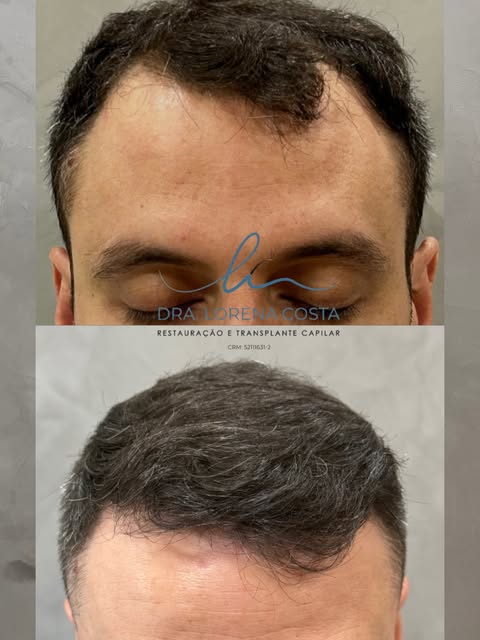 1 ano após o transplante capilar, resultado com extrema naturalidade, como pedido pelo nosso pacient