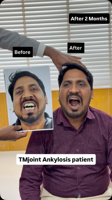 TMJ ankylosis patient → Transformation.
Restricted opening to wide movement.
@drsunilrichardson 
@ri
