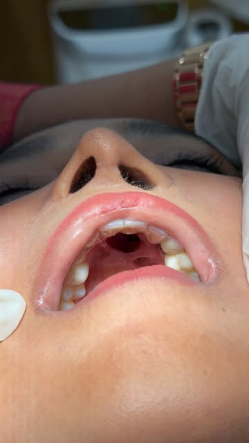Restoring function, restoring confidence. 🦷✨
A digitally designed, 3D-printed obturator for an adul