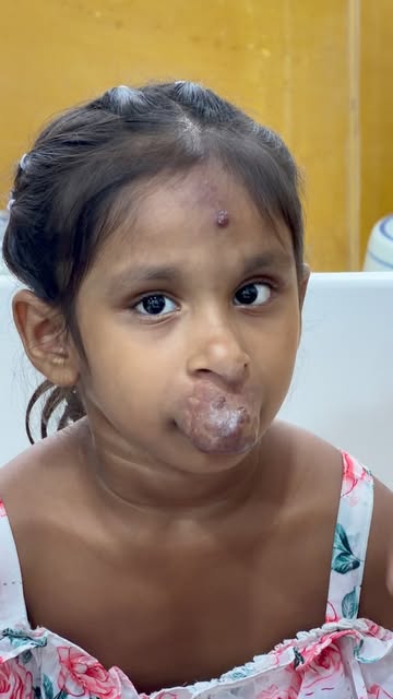 A complex AV malformation involving the upper lip and nasal region.
@drsunilrichardson 
@richardsons