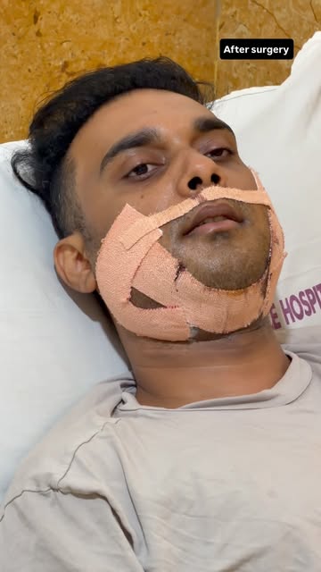 Bimaxillary Advancement for Obstructive Sleep Apnea 

Advancing the jaws to improve airway space, br
