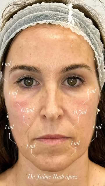 Rejuvenecimiento facial: la clave está en los puntos de abordaje.

Cada rostro envejece de una maner