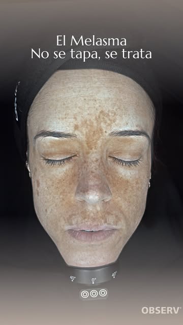 ☀️ El verano es, sin duda, la época en la que el melasma y las manchas faciales suelen hacerse más v