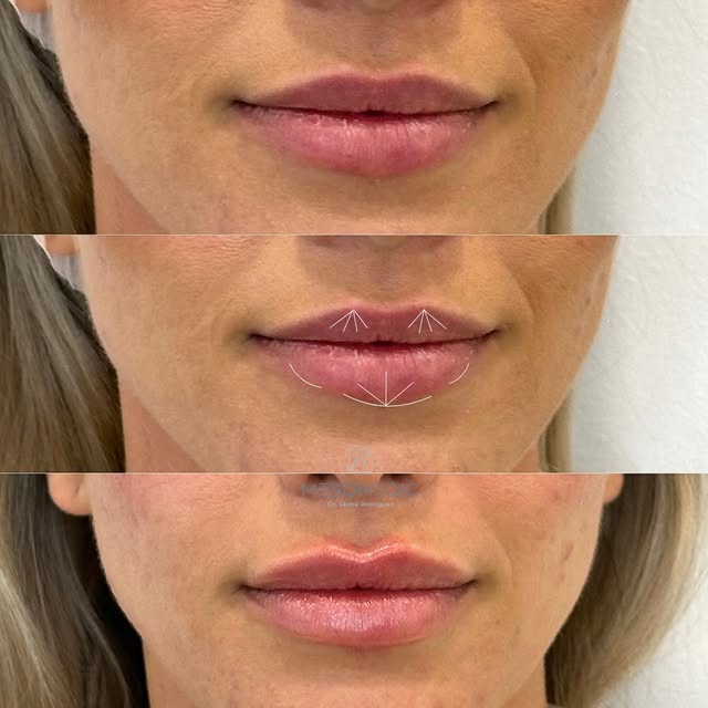 Cada labio es único. Por eso, cada tratamiento también debe serlo. 👄

En el tratamiento de labios n