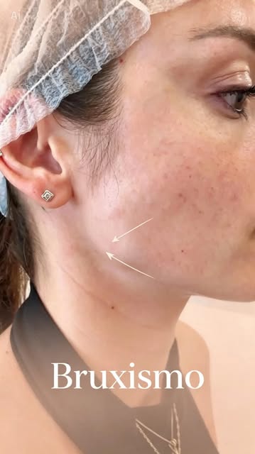 ¿Aprietas los dientes sin darte cuenta? Puede que tengas bruxismo.

El bruxismo es el hábito involun