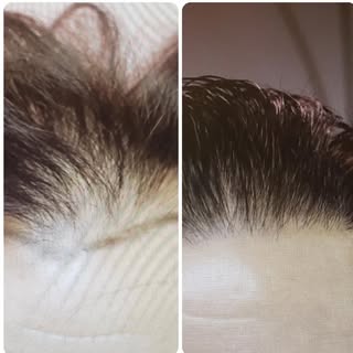 Pre op compared to post op 12 months two thousand graft FUE surgery. #hairsurgeon #hairline #hairres