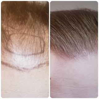 Pre op versus 8 month post op 1600 graft FUE transplant. Call our office for a consult today! (503) 