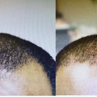 Pre -op compared to post -op at four month follow up. Starting to already see the growth. With about