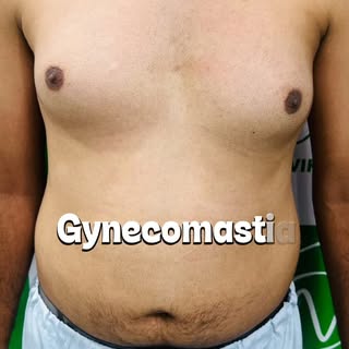 Gynecomastia Surgery Before & After 

A more defined and proportionate male chest can make a noticea