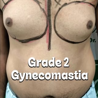 Gynecomastia Surgery in Jaipur

Diet, exercise और gym के बावजूद chest enlargement बना हुआ है? इसका क