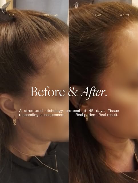 45 days into a structured treatment protocol.

Visible improvement in density along the frontal hair