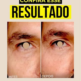 Às vezes, o que parece ser indicação de cirurgia de pálpebras pode ter outra causa.

Nesse caso, hav